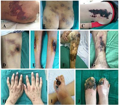 Prevalence and Clinical Characteristics of Calciphylaxis in Chinese Hemodialysis Patients